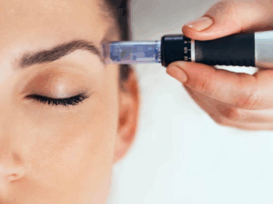 home microneedling